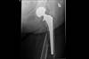 Ortho Dx: Hip Fracture After a Fall Ortho Dx: Hip Fracture After a Fall