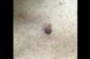 Derm Dx: Itchy Lesion on the Chest Derm Dx: Itchy Lesion on the Chest