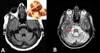 Multiple System Atrophy: A Common Form of Atypical Parkinsonism Multiple System Atrophy: A Common Form of Atypical Parkinsonism