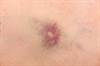 Case Study: Abdominal Pain, Malaise, and a Bruise on the Leg Case Study: Abdominal Pain, Malaise, and a Bruise on the Leg