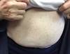Derm Dx: Rash on the Abdomen and Upper Arms Derm Dx: Rash on the Abdomen and Upper Arms