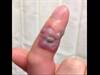 Image of the Week: Targetoid Lesion on the Index Finger Image of the Week: Targetoid Lesion on the Index Finger
