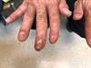 Painful, Recurrent Rash on the Fingers Painful, Recurrent Rash on the Fingers
