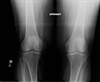 Ortho Dx: Persistent Left Knee Pain Ortho Dx: Persistent Left Knee Pain