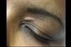 Derm Dx: Asymptomatic Lesion Above the Left Eye Derm Dx: Asymptomatic Lesion Above the Left Eye