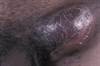Painful Penile Lesions and Groin Swelling Painful Penile Lesions and Groin Swelling