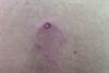 Derm Dx: Erythematous Rash on the Upper Back Derm Dx: Erythematous Rash on the Upper Back