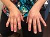 Image of the Week: Erythematous Rash and Muscle Weakness Image of the Week: Erythematous Rash and Muscle Weakness