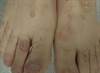 Derm Dx: Asymptomatic Blisters on the Hands, Arms, and Feet Derm Dx: Asymptomatic Blisters on the Hands, Arms, and Feet