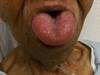 Image of the Week: Acute Swelling of the Tongue Image of the Week: Acute Swelling of the Tongue