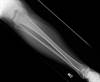 Ortho Dx: Right Leg Pain Following a Hiking Injury Ortho Dx: Right Leg Pain Following a Hiking Injury