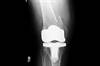 Ortho Dx: How Would You Treat This Patient's Knee Pain? Ortho Dx: How Would You Treat This Patient's Knee Pain?