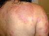 Image of the Week: Erythematous Papules on the Back, Arms, and Hands Image of the Week: Erythematous Papules on the Back, Arms, and Hands