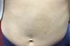 Derm Dx: Hyperpigmented Macule on the Abdomen Derm Dx: Hyperpigmented Macule on the Abdomen