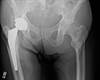 Ortho Dx: Chronic Pain and Stiffness After Total Hip Replacement Ortho Dx: Chronic Pain and Stiffness After Total Hip Replacement