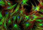 Skin Autofluorescence Predicts T2DM, Heart Disease, Mortality Skin Autofluorescence Predicts T2DM, Heart Disease, Mortality