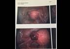 Early Pregnancy and Painless Spotting Early Pregnancy and Painless Spotting