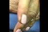 Derm Dx: Swelling in the Finger Following a Cat Scratch Derm Dx: Swelling in the Finger Following a Cat Scratch