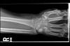 Ortho Dx: How Would You Treat This Patient's Right Wrist Pain? Ortho Dx: How Would You Treat This Patient's Right Wrist Pain?