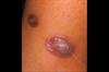 Derm Dx: Asymptomatic Blisters on a Child's Upper Leg Derm Dx: Asymptomatic Blisters on a Child's Upper Leg