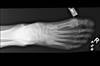 Ortho Dx: What Is Causing This Woman's Toe Pain? Ortho Dx: What Is Causing This Woman's Toe Pain?