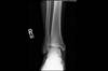 Ortho Dx: Ankle Pain Following a Trampoline Accident Ortho Dx: Ankle Pain Following a Trampoline Accident