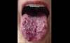 Image of the Week: Purple Lesions on the Tongue Image of the Week: Purple Lesions on the Tongue
