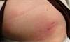 Derm Dx: Skin Rash on the Abdomen, Flank, and Upper Thigh Derm Dx: Skin Rash on the Abdomen, Flank, and Upper Thigh