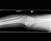 Ortho Dx: Assessing Flexion and Extension During Total Knee Arthroplasty Ortho Dx: Assessing Flexion and Extension During Total Knee Arthroplasty
