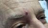 Derm Dx: Asymptomatic Lesion on the Forehead Derm Dx: Asymptomatic Lesion on the Forehead