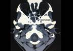 Case Study: Fever and Headache in an Adolescent Boy Case Study: Fever and Headache in an Adolescent Boy