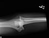Ortho Dx: Elbow Pain and Deformity Following a Martial Arts Injury Ortho Dx: Elbow Pain and Deformity Following a Martial Arts Injury
