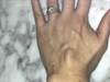 Derm Dx: Firm Nodule on the Hand Derm Dx: Firm Nodule on the Hand
