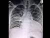 Image of the Week: Worsening Shortness of Breath and Nonproductive Cough Image of the Week: Worsening Shortness of Breath and Nonproductive Cough