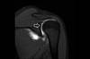 Ortho Dx: Shoulder Pain in a Volleyball Player Ortho Dx: Shoulder Pain in a Volleyball Player