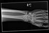 Ortho Dx: How Would You Treat This Ulnar Styloid Fracture? Ortho Dx: How Would You Treat This Ulnar Styloid Fracture?