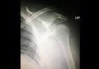 Case Study: Shoulder Injury Following a Biking Accident Case Study: Shoulder Injury Following a Biking Accident