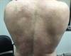 Derm Dx: Can You Diagnose This Patient's Rash? Derm Dx: Can You Diagnose This Patient's Rash?