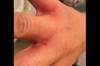 Image of the Week: Erythematous Papules in the Web Spaces Between the Fingers Image of the Week: Erythematous Papules in the Web Spaces Between the Fingers