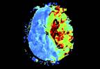 Assessment of Dual Antiplatelet Therapy After Stroke, TIA Assessment of Dual Antiplatelet Therapy After Stroke, TIA