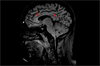 Image of the Week: A 2-Year History of Headaches and Blurred Vision Image of the Week: A 2-Year History of Headaches and Blurred Vision