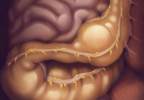 Opioid-Induced Constipation: Insights Into Diagnosis and Effective Treatment Opioid-Induced Constipation: Insights Into Diagnosis and Effective Treatment