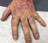Derm Dx: Erythematous, Scaling Plaques and Pitting of the Nails Derm Dx: Erythematous, Scaling Plaques and Pitting of the Nails