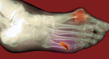 Serum Estradiol Levels Predictive of Fractures During Menopausal Transition Serum Estradiol Levels Predictive of Fractures During Menopausal Transition