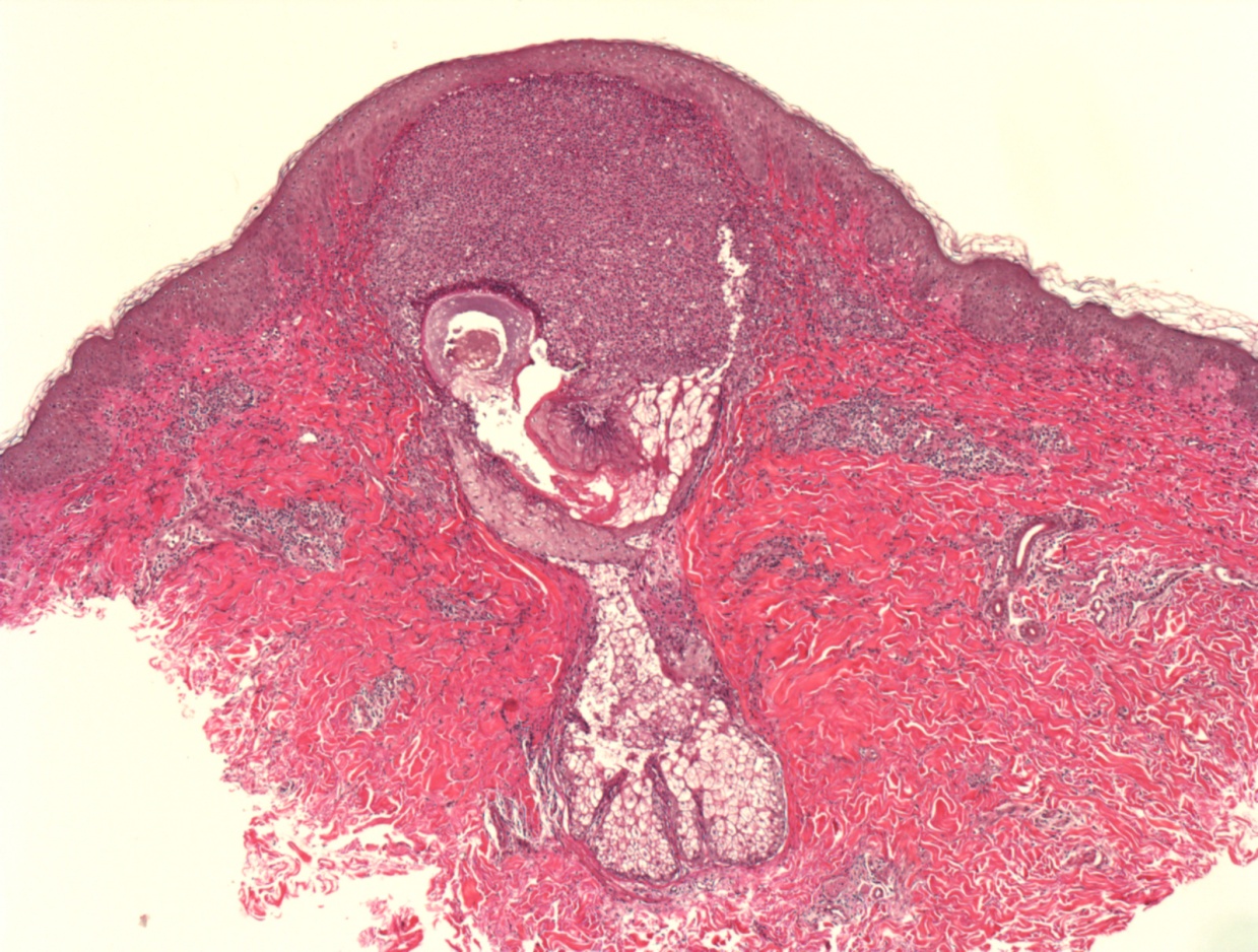 folliculitis on vag folliculitis on vag