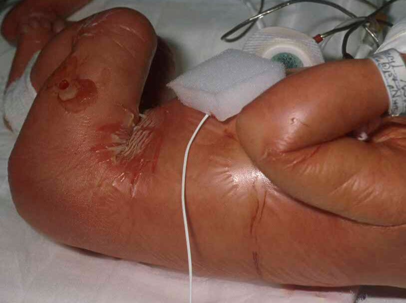 Lamellar Ichthyosis (autosomal recessive congenital