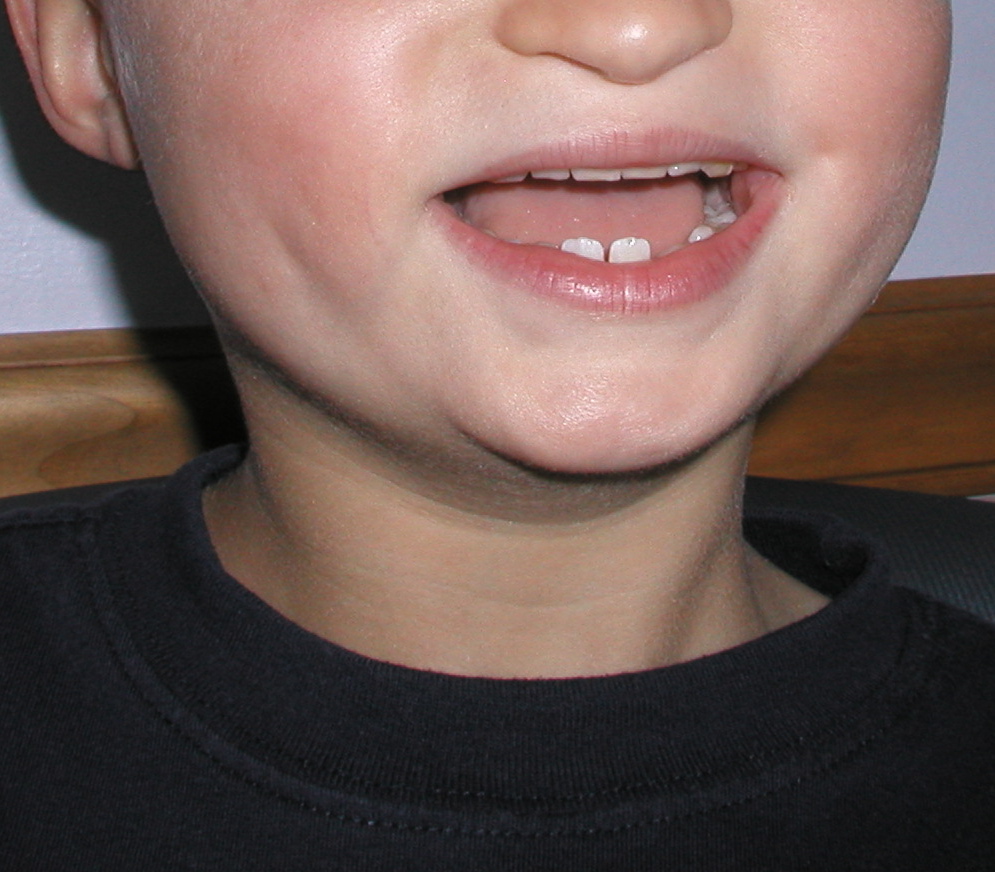 Ichthyosis, Xlinked (Steroid sulfatase deficiency; STS deficiency