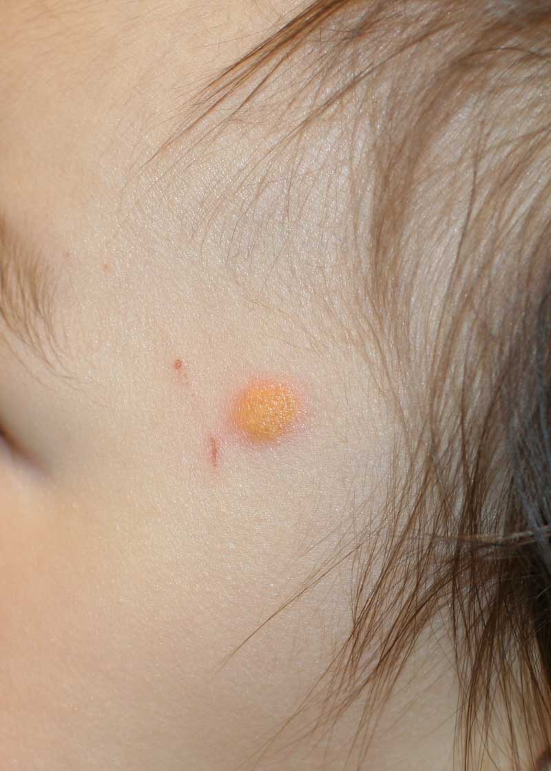 Juvenile xanthogranuloma (JXG) - The Clinical Advisor