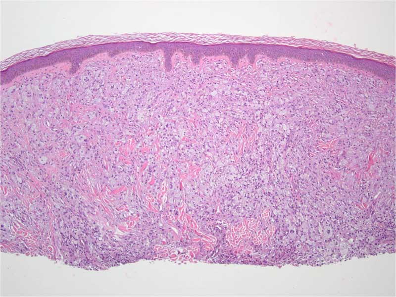 Juvenile xanthogranuloma (JXG) The Clinical Advisor