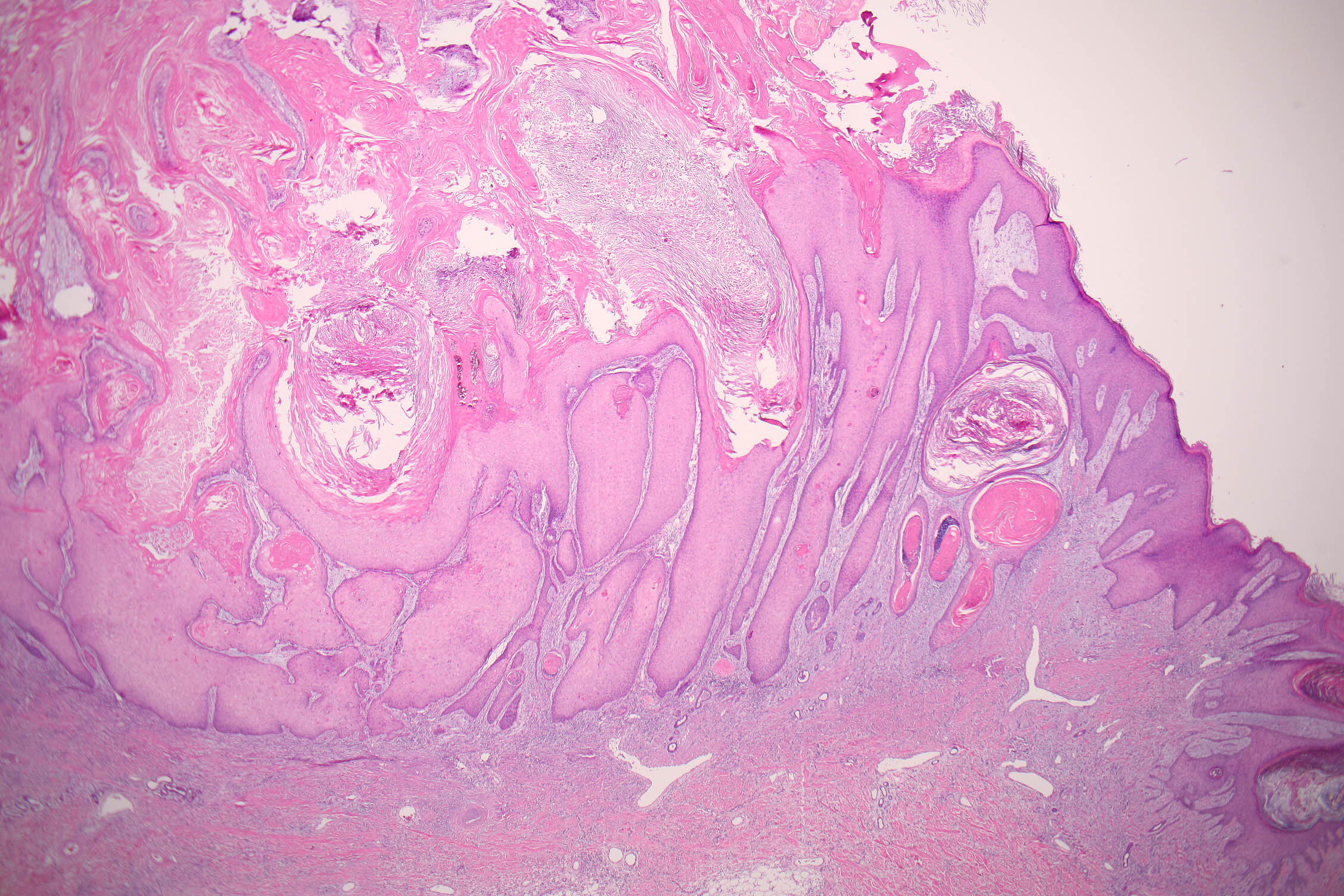 Keratoacanthoma (Squamous cell carcinoma of the keratoacanthoma type